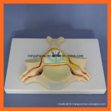 Fifth Cervical Vertebra with Spinal Cord and Spinal Nerve Enlarge Model